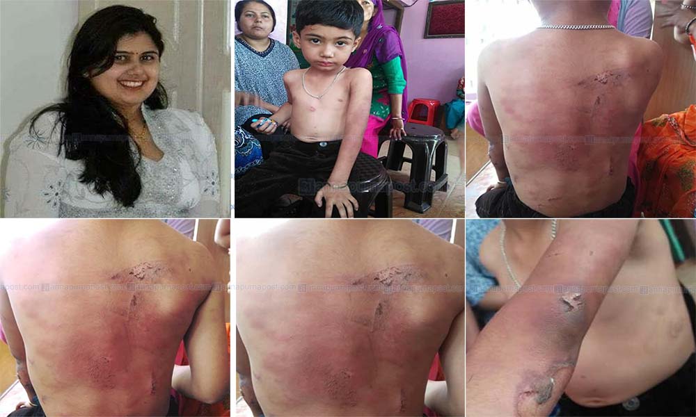 Child-torture-by-mum-biratnagar6