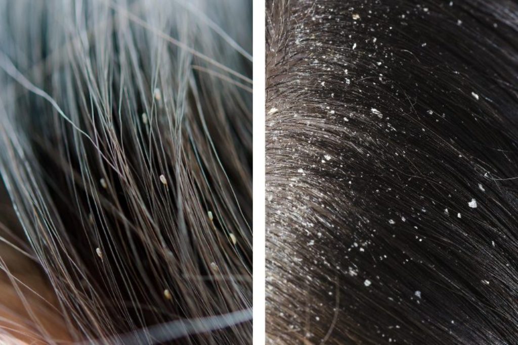 dandruff-