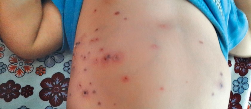 scrub_typhus_uyUzIyqCtr (1)