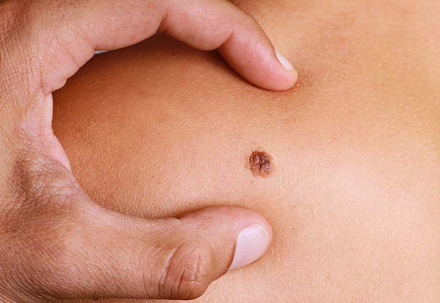 skin-cancer-now-what-1