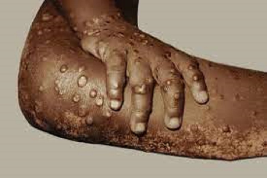 Monkeypox-मङ्कीपक्स