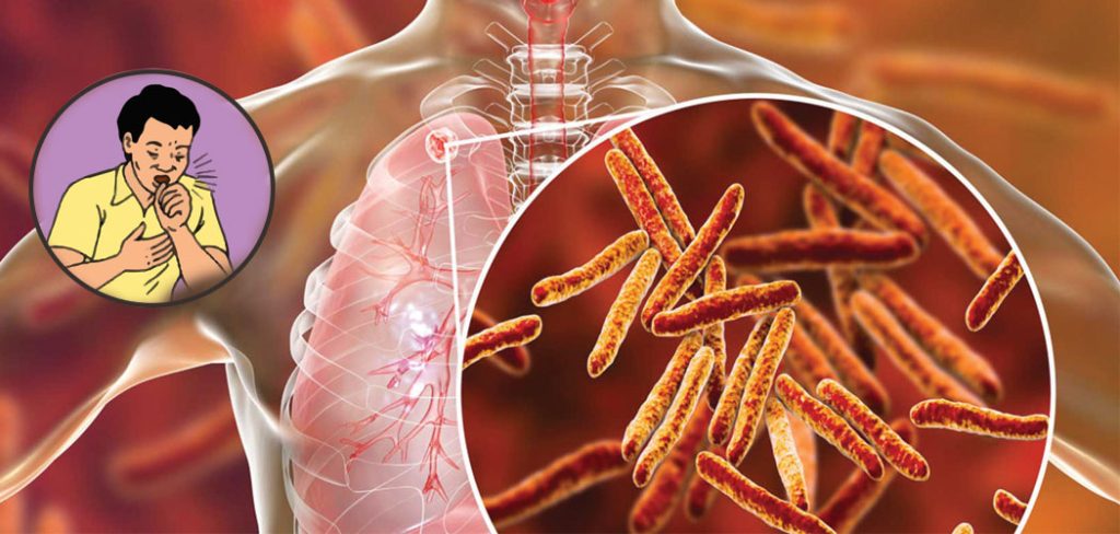 TB-disease-file-pic